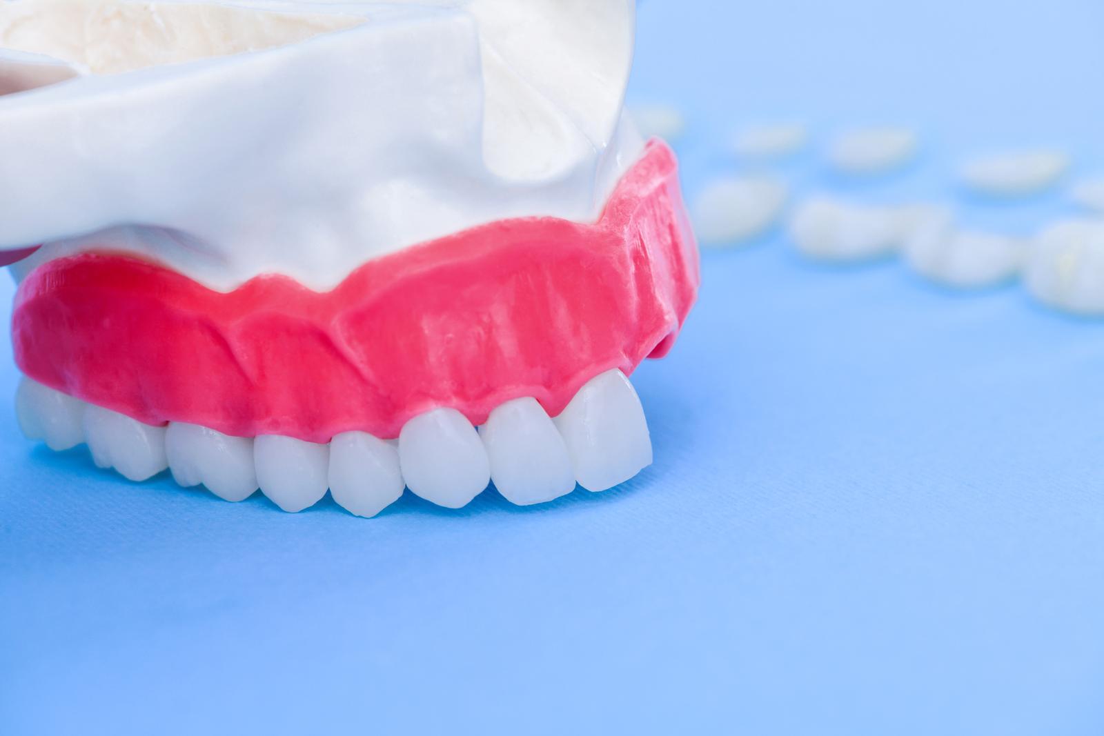 Find Out: Does Dental Insurance Cover Veneers?