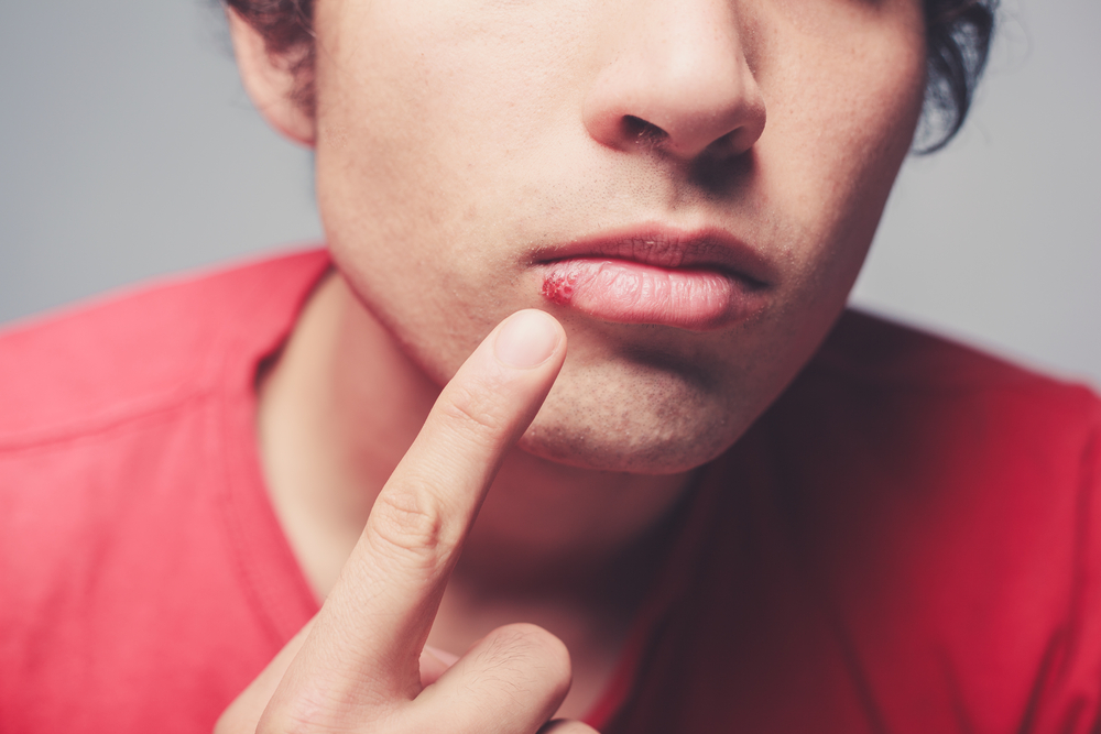 How To Get Rid Of Cold Sores: Treatment Methods For Quick Recovery