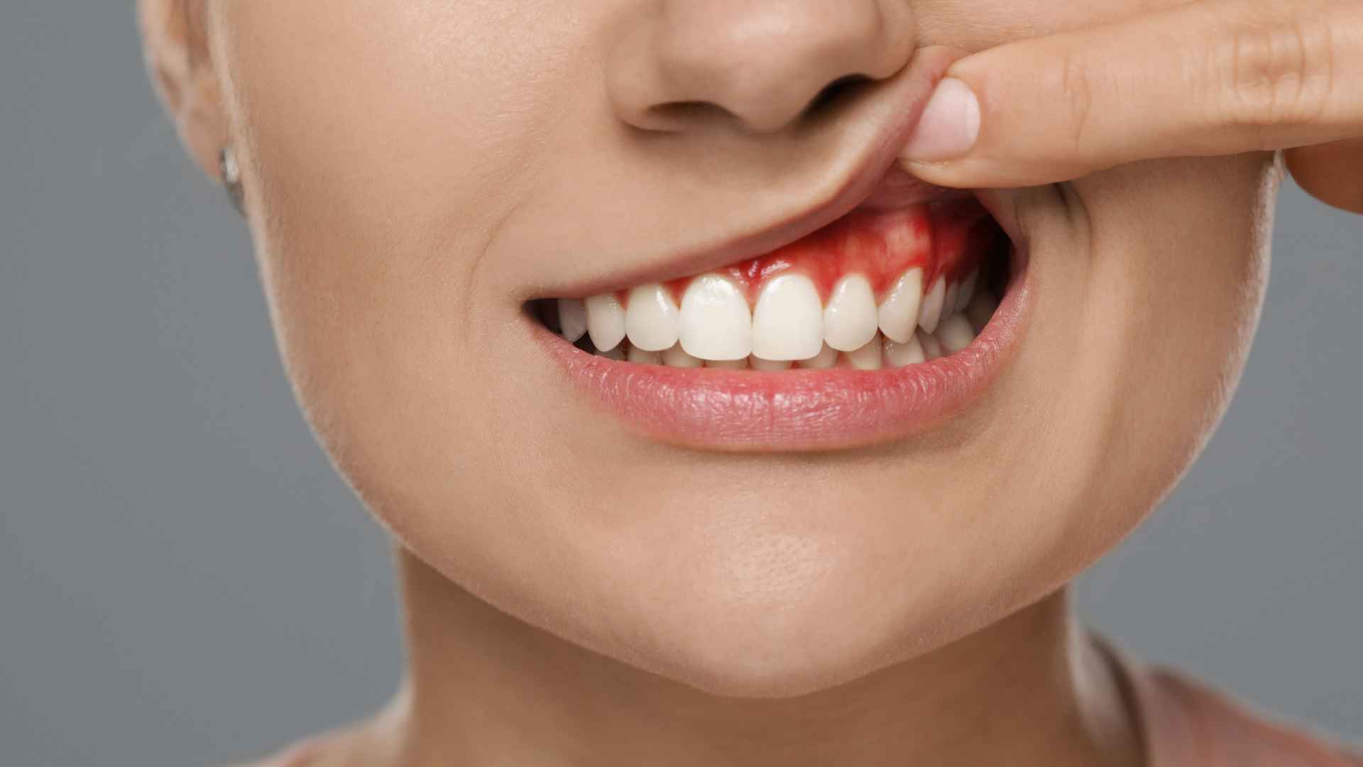 What Is A Gum Boil? Causes, Symptoms, And When To See A Dentist