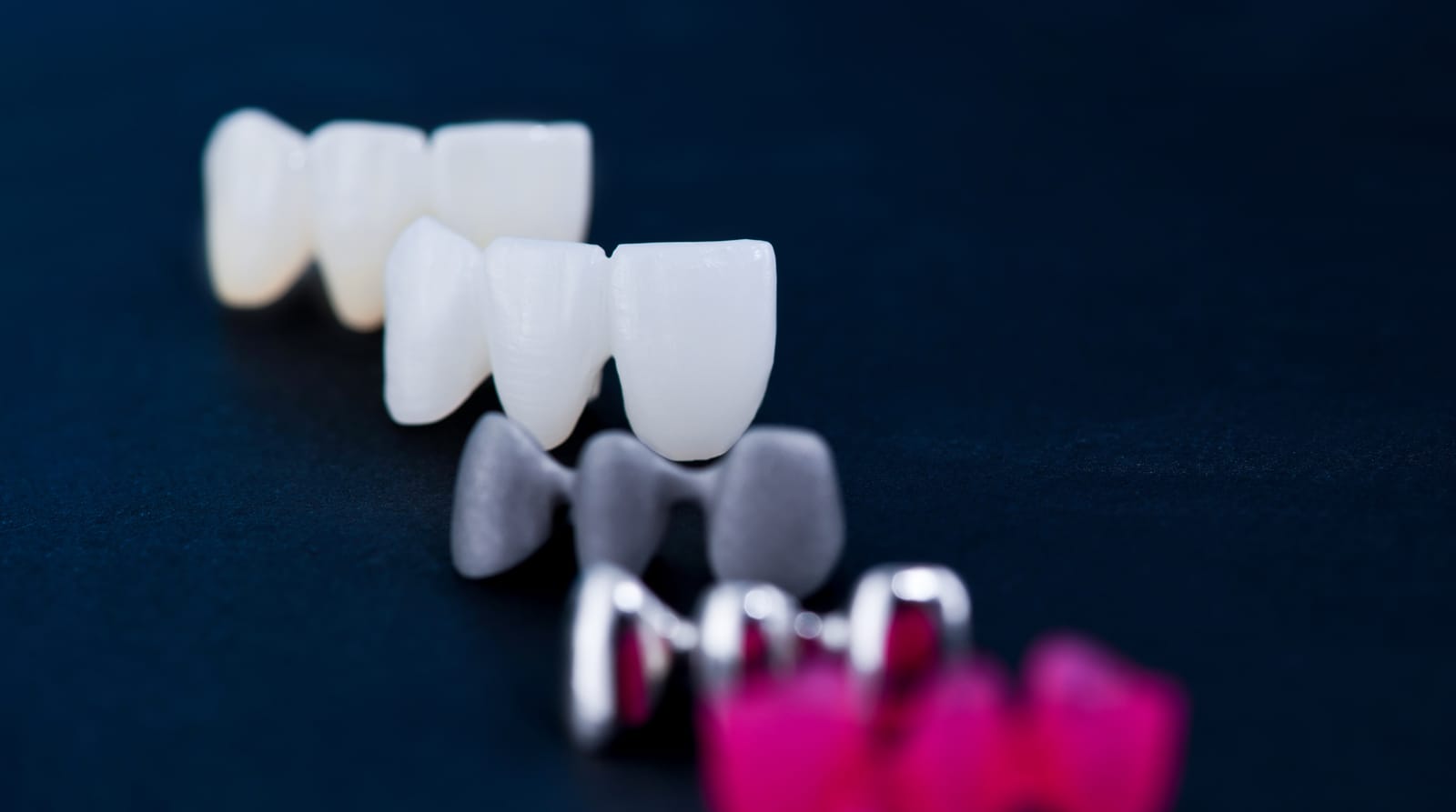 Understanding The Cost For A Crown: What’s The Average Price &#   ; What Affects It?