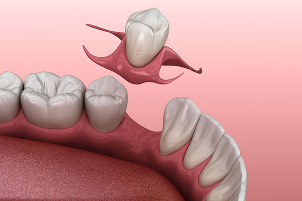 Partial Denture for One Missing Tooth: Can It be a Removable Denture? from St. George Dental Care in St George, UT