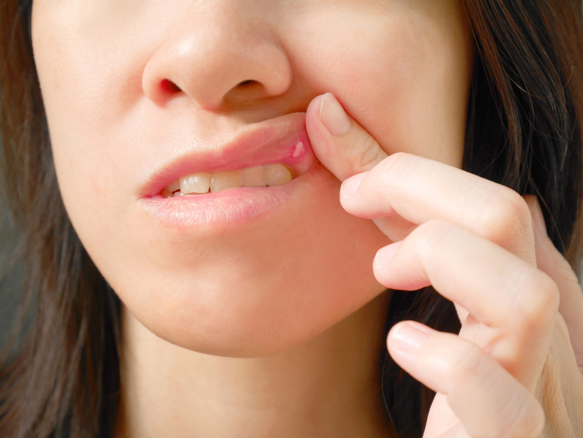 How To Get Rid Of A Canker Sore Fast: Remedies That Actually Work
