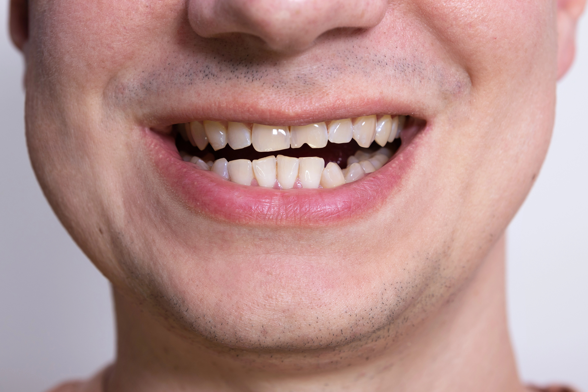 Chipped A Tooth? Here&#    ;s What Dentists Recommend You Do Next