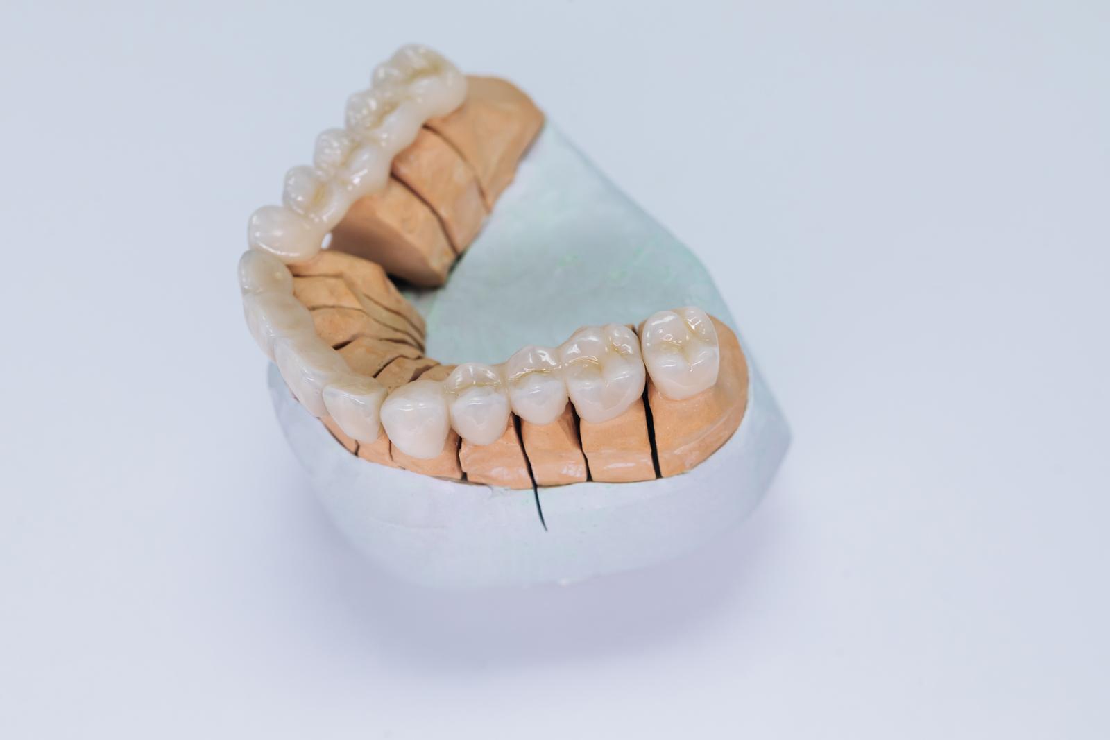 Composite Veneers Vs Porcelain Veneers: Which Is Best For You?