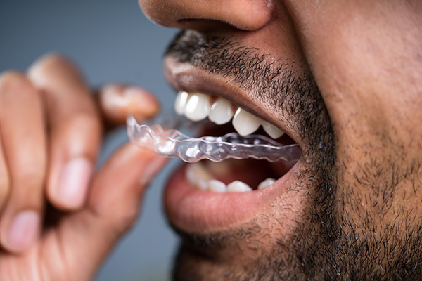 A Cosmetic Dentist Explains Benefits of Clear Aligners from St. George Dental Care in St George, UT