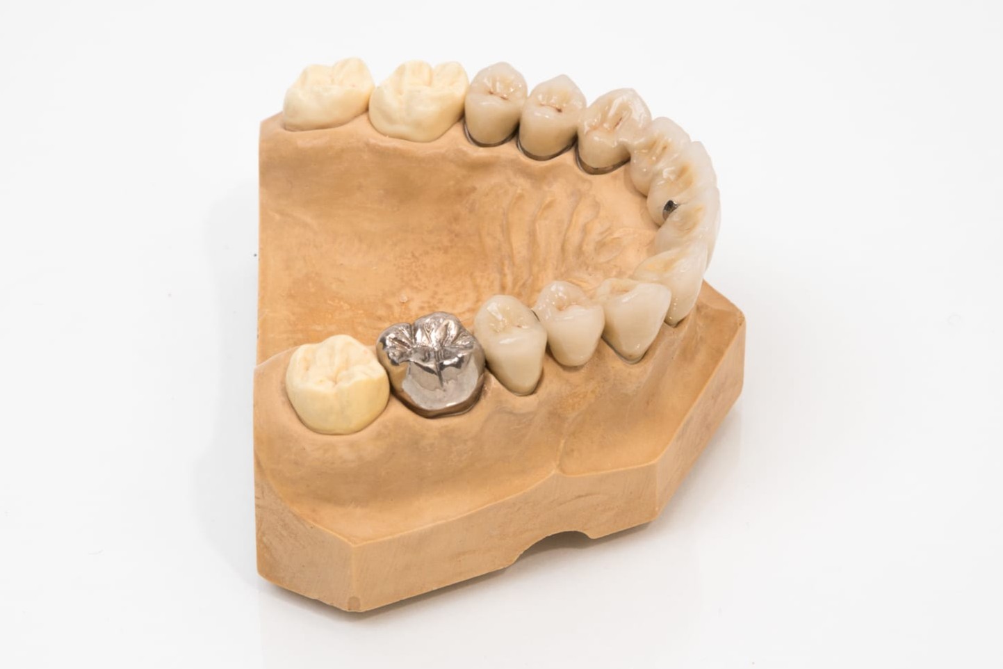 Crown Vs Filling Vs Extraction: Which Dental Treatment Is Right For You?