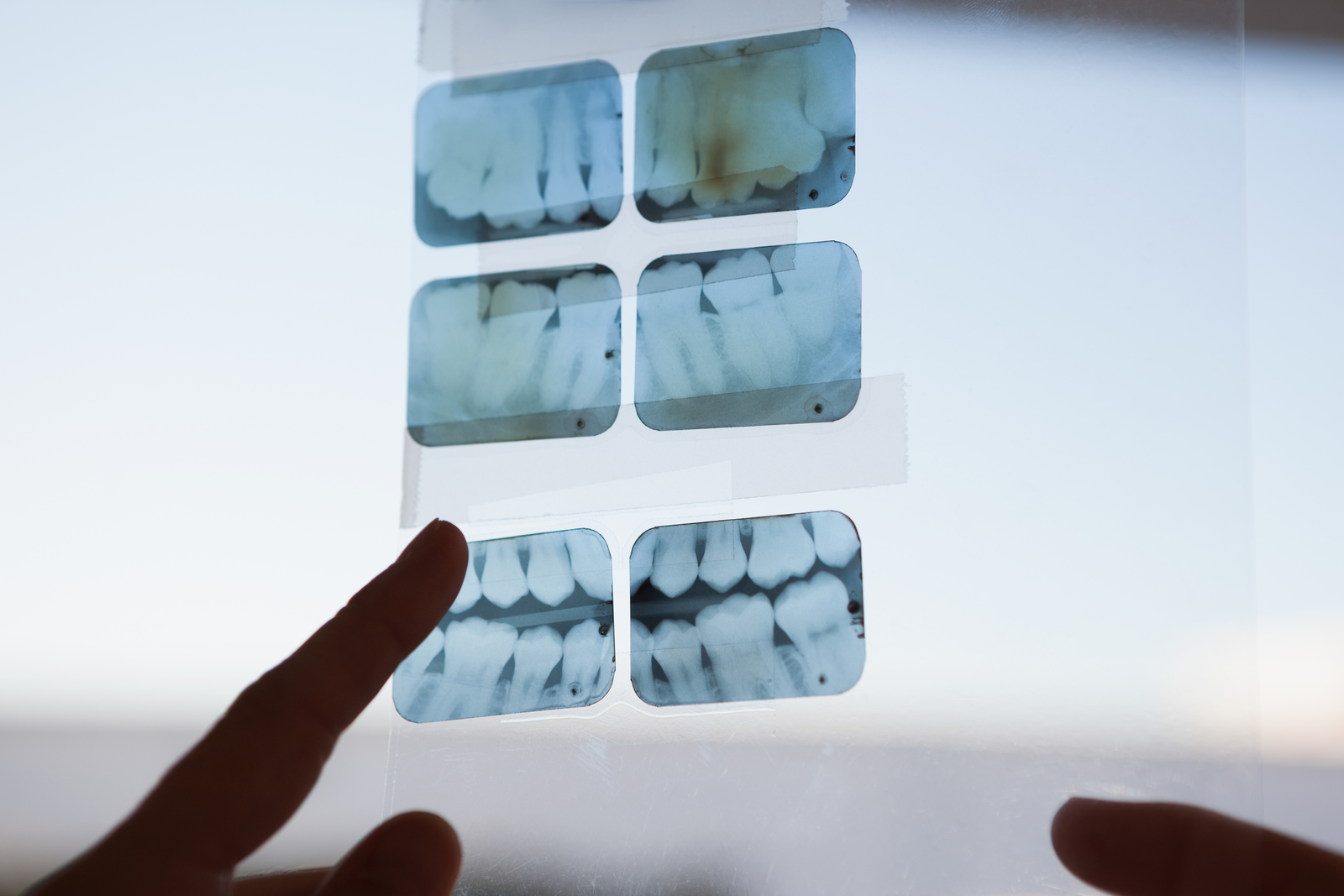 Exploring The Dangers Of Dental Crowns And How To Avoid Them