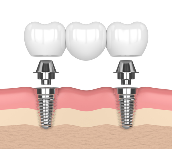 Dental Implants St George, UT