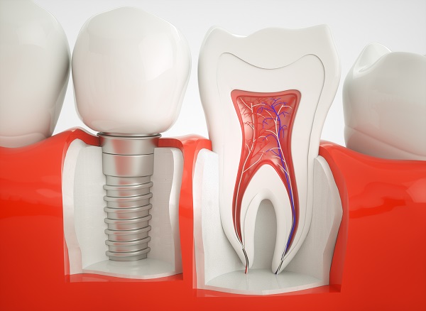 An Implant Dentist Discusses Missing Tooth Replacement Options