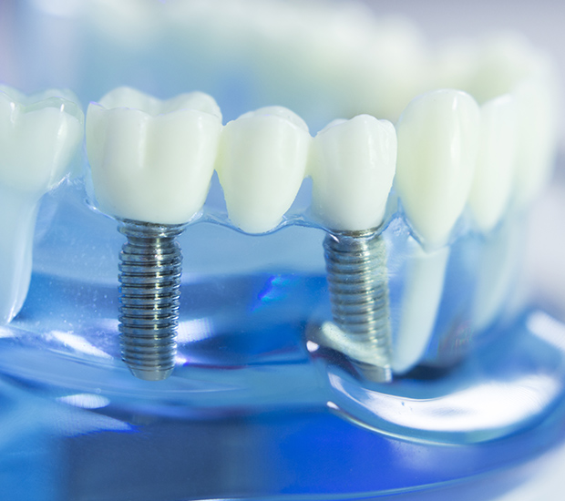 St George Dental Implants