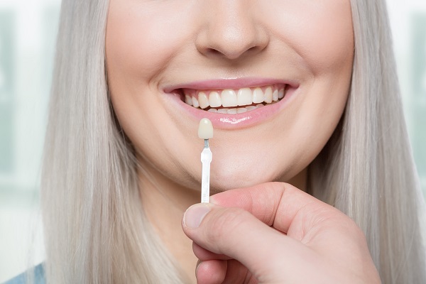 How Veneers Have Changed Over Time