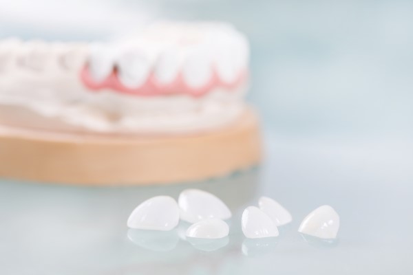 Are Dental Veneers Permanent?