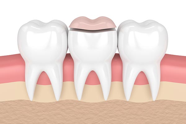 How a Cosmetic Dentist Can Place Inlays and Onlays from St. George Dental Care in St George, UT