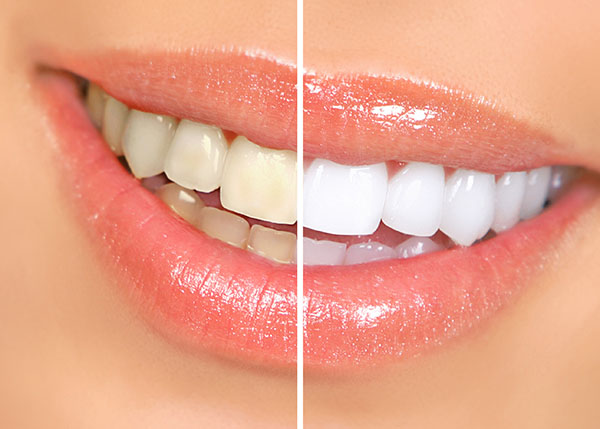 Professional Teeth Whitening Dentist