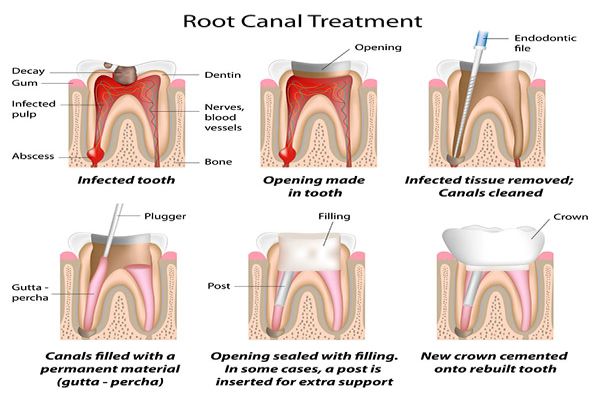 Root Canal Dentist