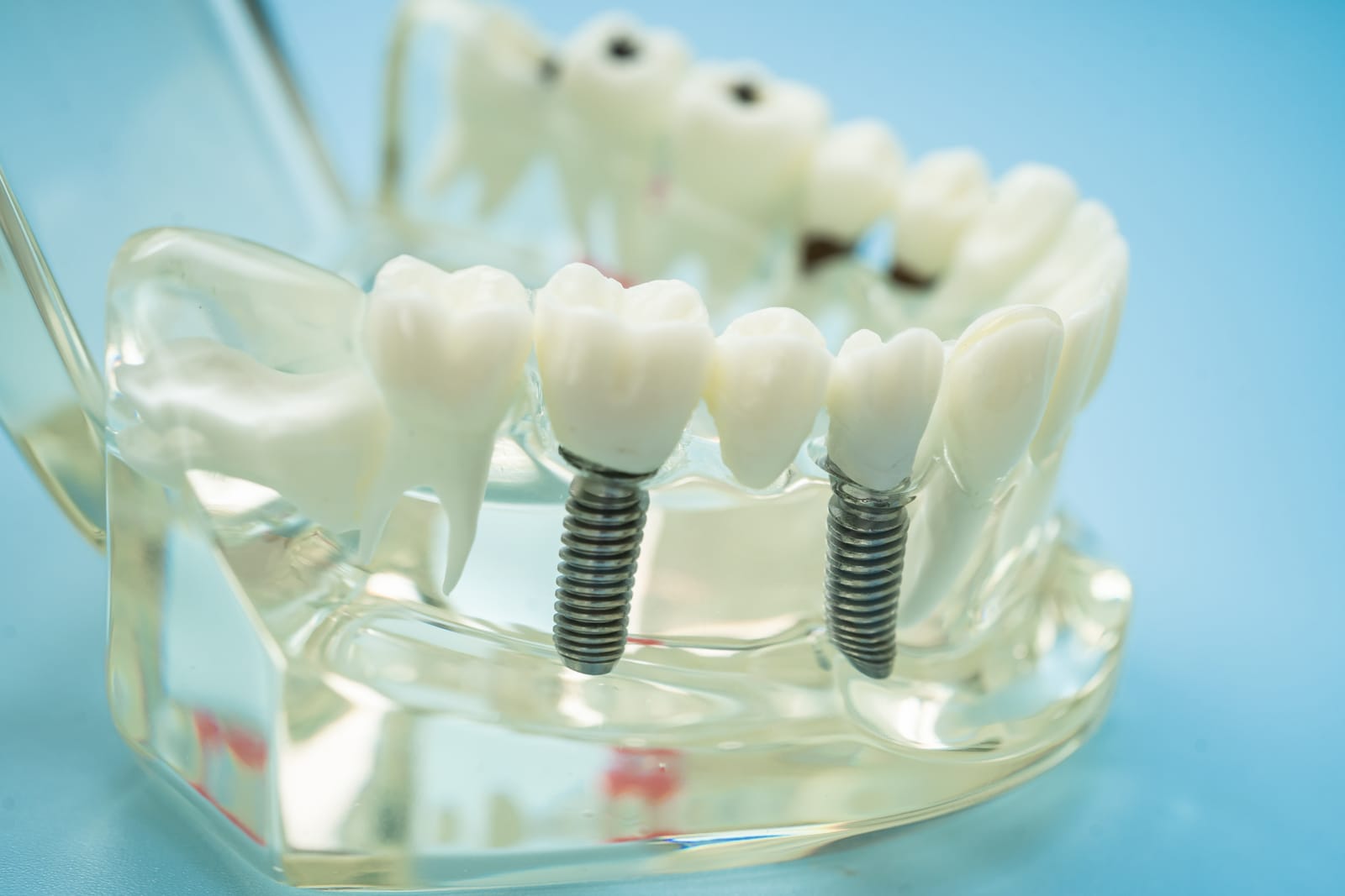 Signs You May Need A Root Canal Before The Pain Gets Worse