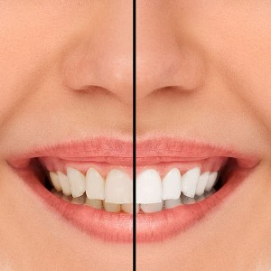 teeth-whitening-in-st.-george