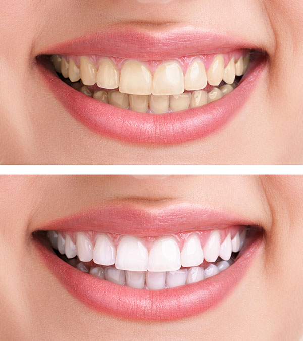 Professional Teeth Whitening Brands   Learn The Process