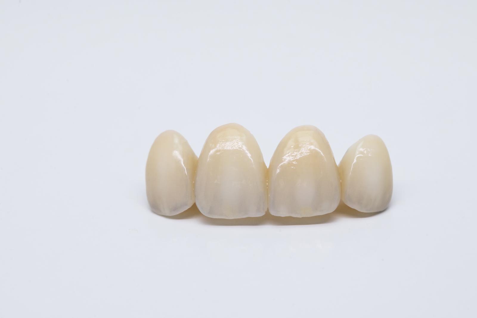 Signs Of Tooth Decay Under Crown And What To Do
