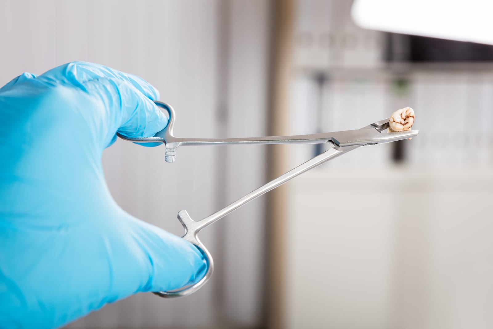 Root Canal Vs Extraction: Which Option Is Better For Your Long Term Oral Health?